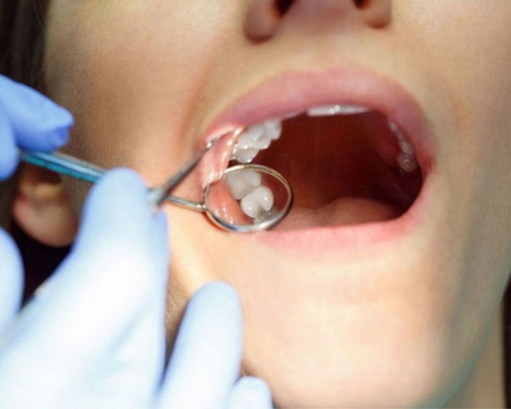 Răng khôn là gì Những kiến thức cần biết khi nhổ răng khôn
