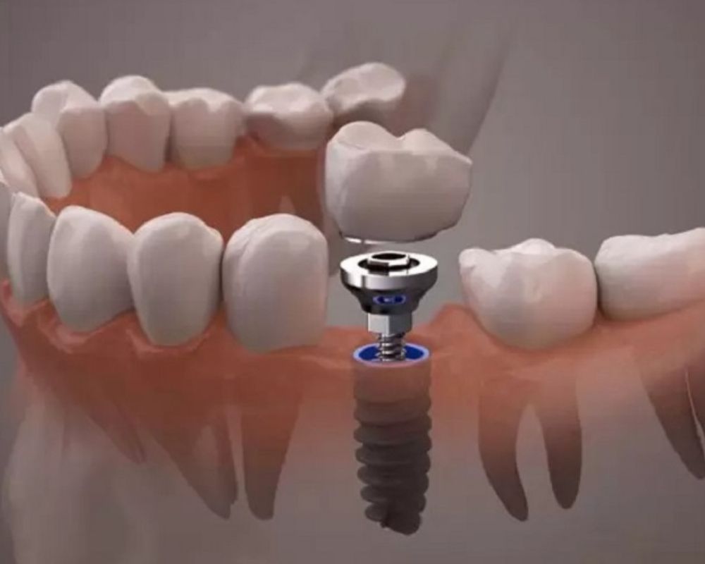 Trồng răng Implant giá bao nhiêu Yếu tố ảnh hưởng đến chi phí